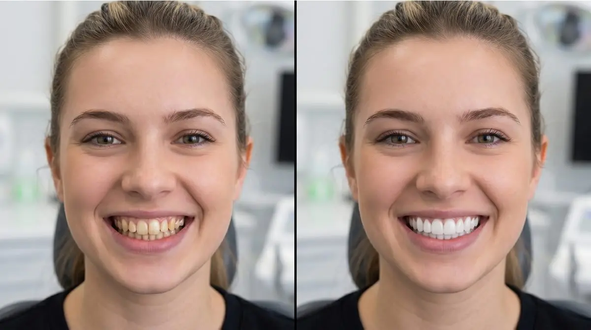 Teeth looking brighter after stopping smoking